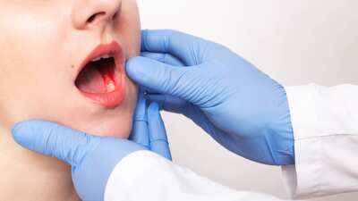 Oral Cancer Treatment Market Size and Forecast by 2028