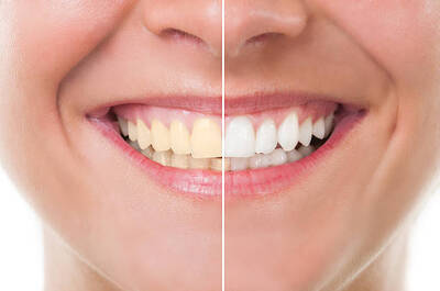 Riyadh Bright Smiles: Transformative Teeth Whitening Solutions