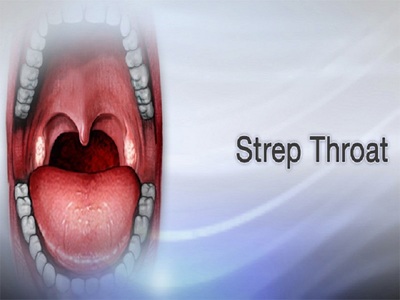 The Incredible Impact of Strep Throat Without Tonsils